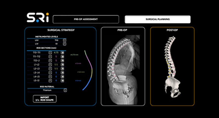 Second U.S. Patent Awarded to Spinal Resources for Multi-Diameter Spinal Fixation Rod